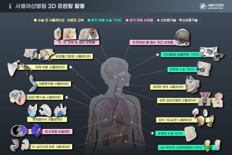 서울아산병원, 3D프린팅 도입 10년..."의료 혁신 선도"