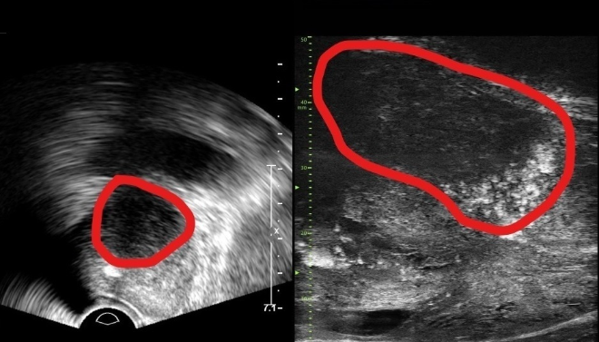 분당서울대병원, 전립선 종양 평가 가능한 ‘마이크로 초음파’ 도입