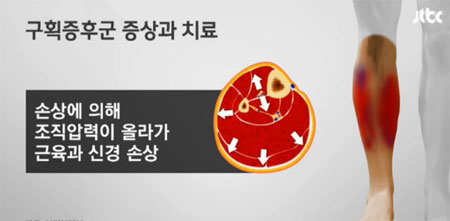 급성구획증후군, 조직압력 측정시 30mmHg 의심할 수 있어