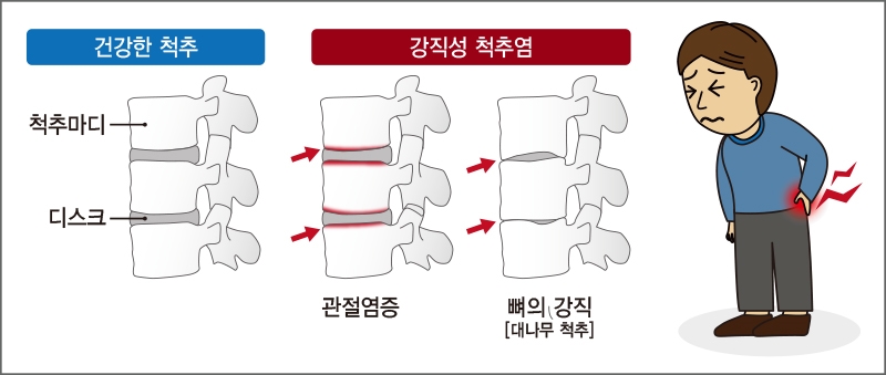 강직성척추염 이미지(사진=강동경희대병원 제공)