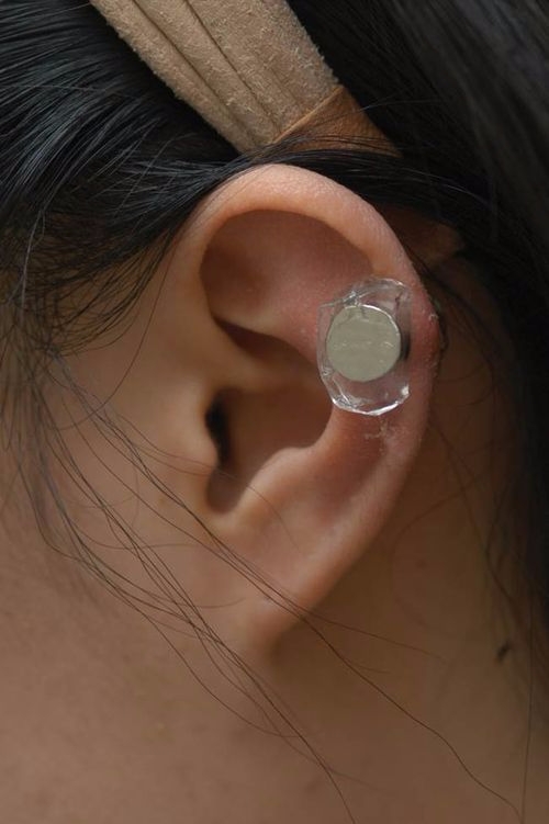 실리콘 겔 시트와 자석 압박을 이용한 치료 장면(사진=분당차병원)