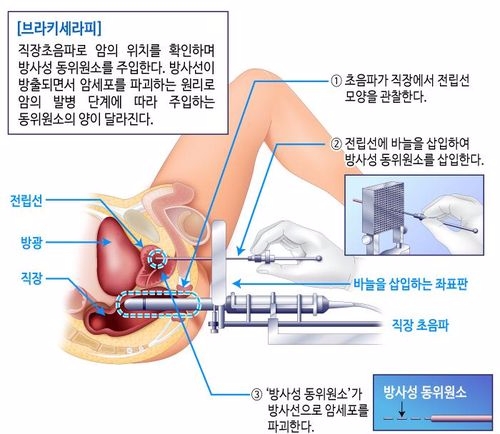 브라키테라피 시술 모식도(사진=분당차병원)