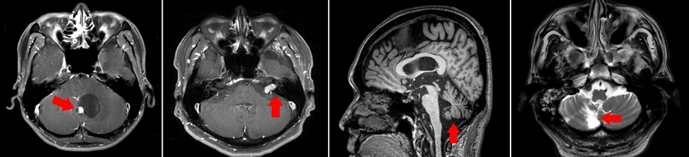 중추성 어지럼증의 유발질환 - 좌측부터 소뇌종양, 전정신경초종, 다발신경계위축증(퇴행성 뇌질환), 뇌경색 (사진=분당서울대)