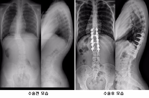 후방척주절제술 수술 11년 후 모습(사진= 인제대학교 상계백병원)