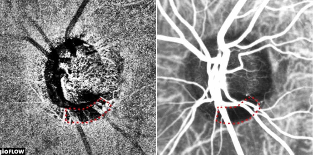 빛간섭단층 혈관조영검사(좌) 및 인도시아닌그린 혈관조영검사(우)로 얻은 녹내장 환자의 시신경유두 이미지. 붉은색 점선으로 둘러싸인 비관류 영역(혈류가 감소한 영역)이 일치한다.