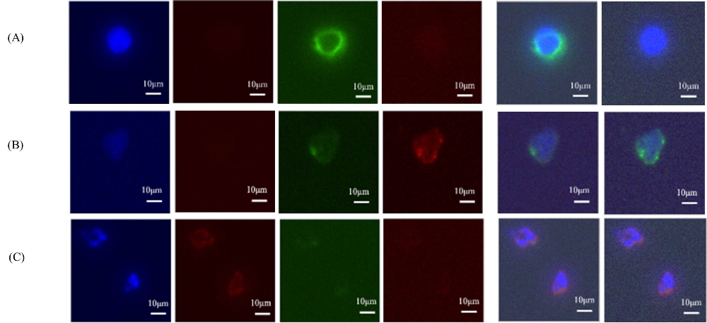그림1. 말초혈액에서 채취된 혈중암세포의 면역염색 사진.