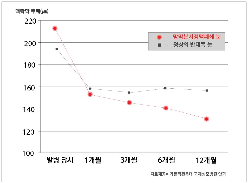 망막분지정맥폐쇄 맥락막 감소 관계 (사진=국제성모병원)