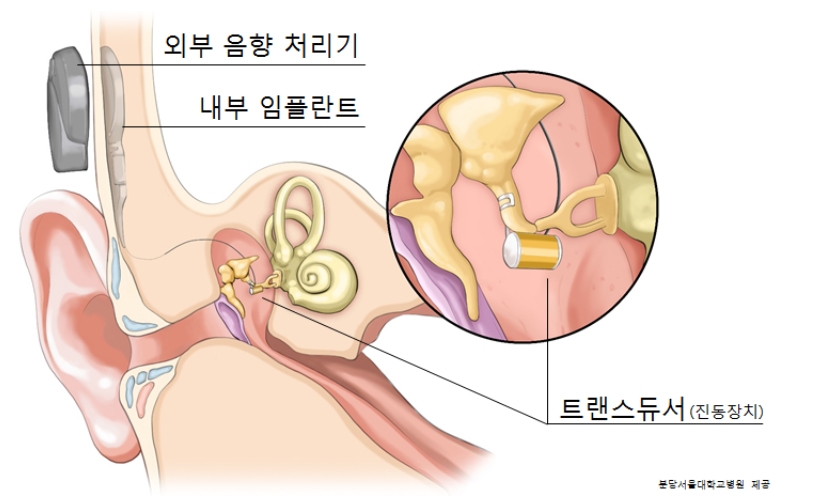 인공중이(중이임플란트) 이식수술 후 모식도 (사진=분당서울대병원)