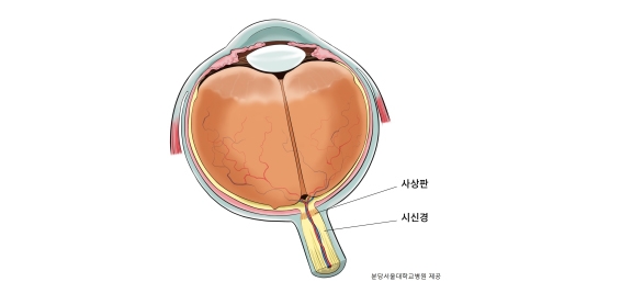 그림1. 시신경 내부에 밴드처럼 생긴 부분이 사상판이다.