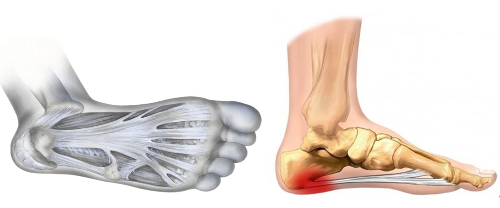 족저근막과 족저근막염 발생 부위 (사진=인제대 벽병원)