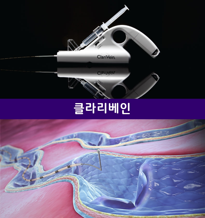 유펙스메드, 하지정맥류 치료기기 클라리베인 출시