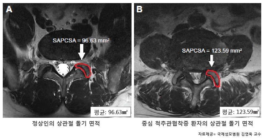 (사진=연구결과(MRI 영상 비교)