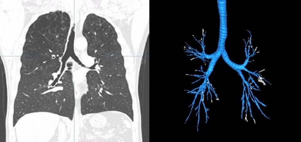 흉부 CT 사진(좌)과 기관지 인공지능 분석 결과(우)