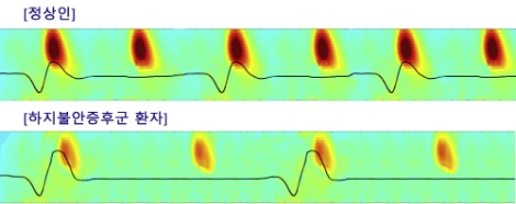 위쪽 붉은색 덩어리 부분이 수면방추, 아래쪽 선에서 나타난 굴곡이 느린진동. 정상인은 1분 동안 평균 수면방추 6회, 느린진동 3회가 나타나는 것에 비해 하지불안증후군 환자는 각각 4회, 2회에 그친다. 사진=서울대병원