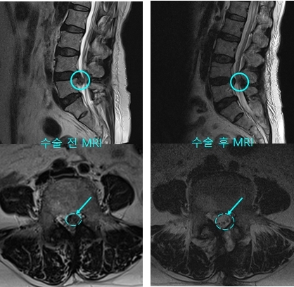 추간판탈출증 환자의 수술 전후 MRI 영상. 사진=인천성모병원