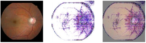 눈의 혈관 및 해부학적 구조를 이용해 동맥경화를 예측하는 인공지능 모형. 사진=서울대병원
