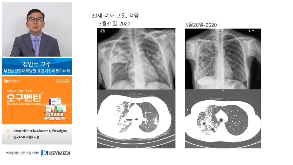 일성신약 오구멘틴 웹 심포지엄 진행