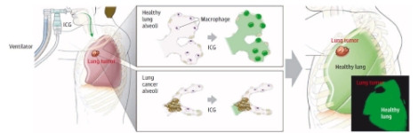 형광조영제에 의한 폐암 경계면 탐색 원리. 사진=한국연구재단