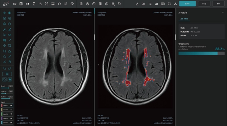 제이엘케이, ‘뇌 백질변성 정량 분석 AI 연구’ 국제 저널 게재