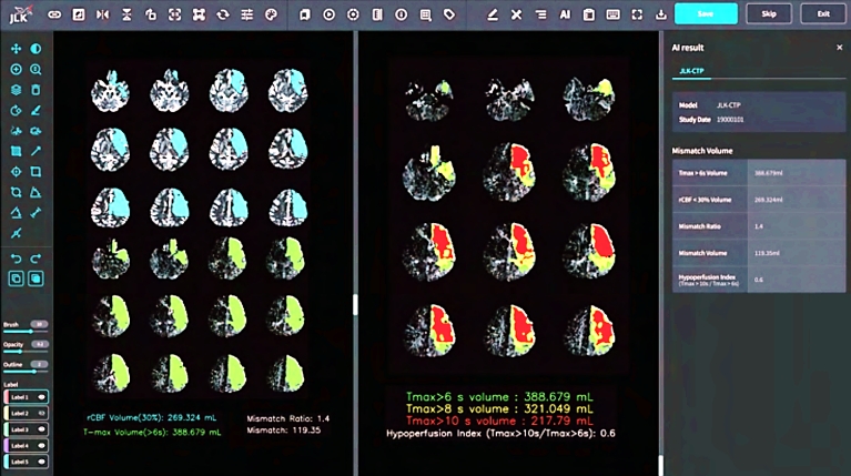뇌 관류영상 분석 AI 솔루션 JLK-CTP. 사진=제이엘케이