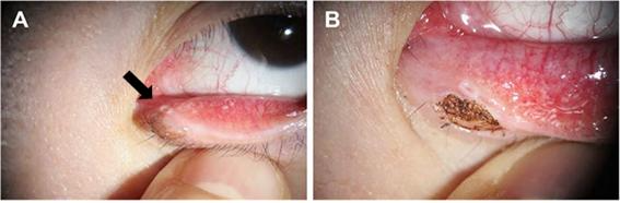 건국대병원 신현진 교수,레이저 이용한 눈꺼풀 양성종양 제거술 개발