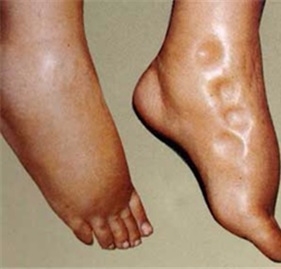 신증후군 환자의 다리 부종(사진=경희대병원)