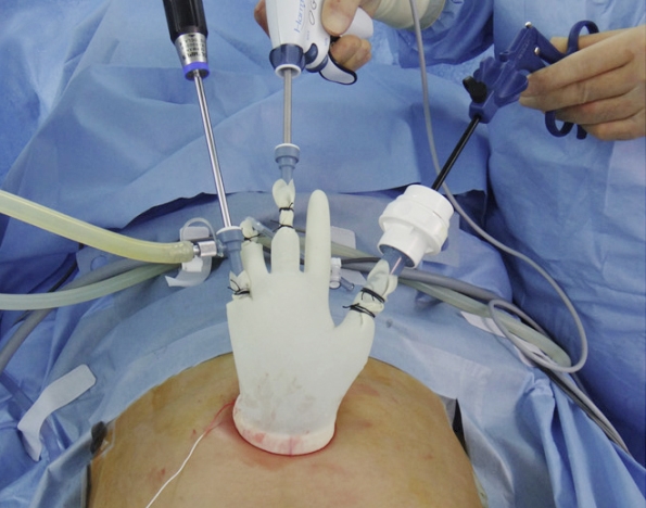 단일절개 복강경 수술 장면(사진=분당서울대)