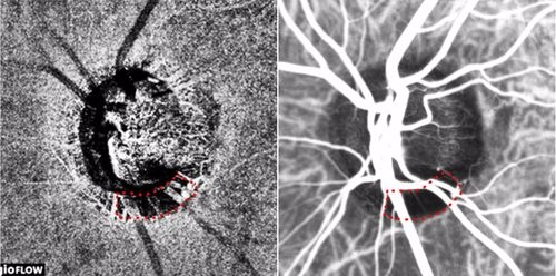 빛간섭단층 혈관조영검사(좌) 및 인도시아닌그린 혈관조영검사(우)로 얻은 녹내장 환자의 시신경유두 이미지. 붉은색 점선으로 둘러싸인 비관류 영역(혈류가 감소한 영역)이 일치한다(사진=분당서울대병원)