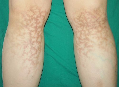 다리저온화상(사진=고려대 안산병원)