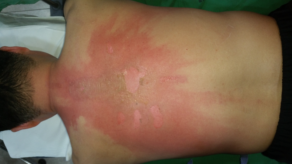 전기장판을 사용하다 잠이 들어 저온화상을 입은 환자(사진=인천성모병원)