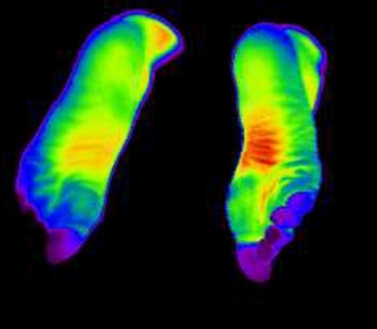 적외선으로 촬영된 수족냉증 환자의 발. 발끝의 온도가 다른 부위에 비해 현저히 낮을 것을 볼 수 있다.(사진=자생한방병원)
