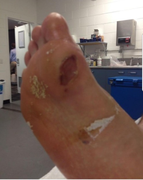 테니스 정현 선수 발바닥 부상 사진 (사진=건대병원)