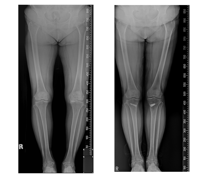 ▲임상결과 사진설명 : (좌) 수술 전  / 여성, 61세, (우측) ‘휜다리 교정술’과 ‘줄기세포 연골재생술’ 후 약 1년 경과. (사진= 강남 연세사랑병원)