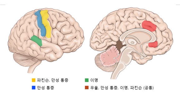 인공지능이 분석해 낸 질환 별 뇌파의 작용 부위 (사진=분당서울대)