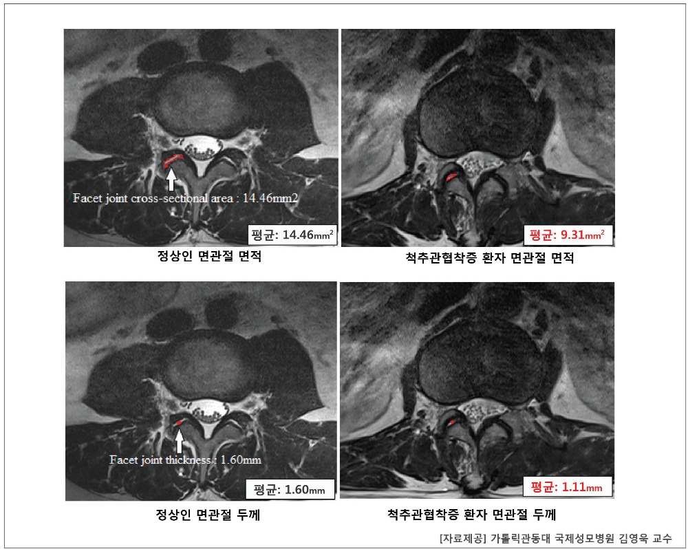 ‘면관절의 비대’는 올바른 표현이 아니라는 논문결과 (사진=국제성모병원)