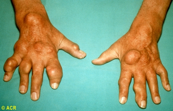만성결절 통풍환자의 손 (사진=인천성모병원)
