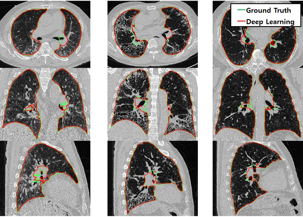 딥러닝 기반 인공지능 네트워크로 분할한 폐 의료영상 사진