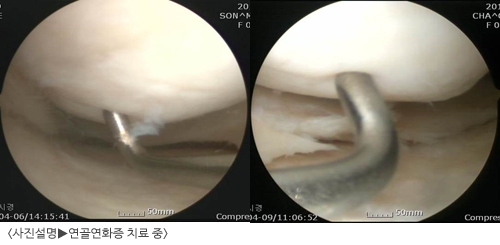 '제한적 의료기술' 줄기세포 치료, 시큰거리는 무릎 통증 '연골연화증' 잡는다