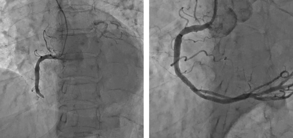 사진=심근경색 환자의 치료 전(왼쪽)과 치료 후(오른쪽)