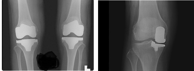 인공관절 부분치환술 vs 전치환술 비교 (사진=더본병원)