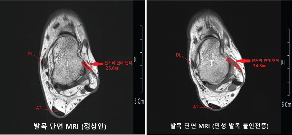 발목 단면 MRI 비교 (사진=국제성모병원)