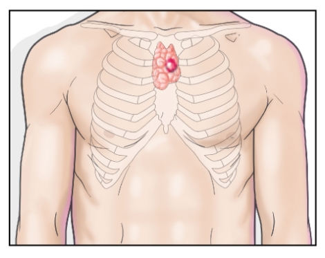면역세포 만드는 흉선, 퇴화 안되면 흉선암·중증근무력증 원인
