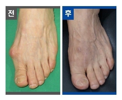 맨발 드러내기 꺼려지는 엄지발 변형 ‘무지외반증' 치료법은?