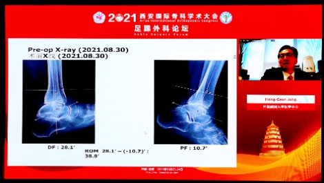 건국대병원 정홍근 교수, 中 시안 홍휘 병원 심포지엄서 ‘발목관절염의 수술적 치료’ 주제 강연