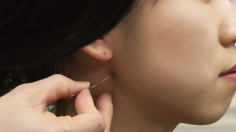 자생한방병원, 턱관절 장애에 대한 침치료 유효성 임상연구 분석