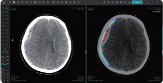 비조영 CT 영상 분석 뇌 경막하 출혈 탐지 솔루션 JLK-SDH