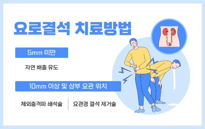 갑작스런 옆구리 통증 ‘요로결석’...수분 섭취와 정기 검진으로 예방해야